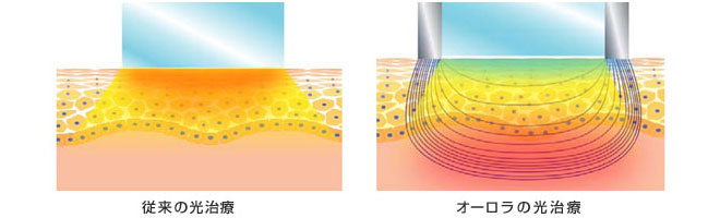 オーロラ治療の仕組み