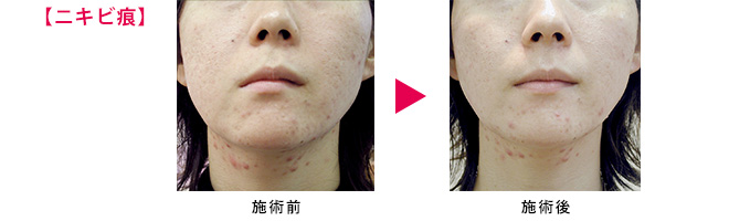 ニキビ痕施術前後