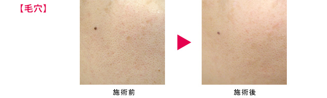 毛穴施術前後
