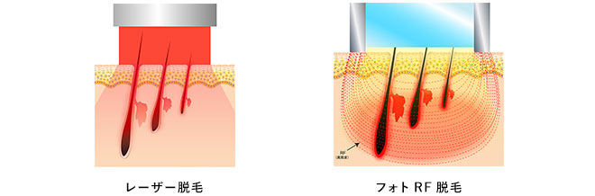 フォトＲＦ脱毛