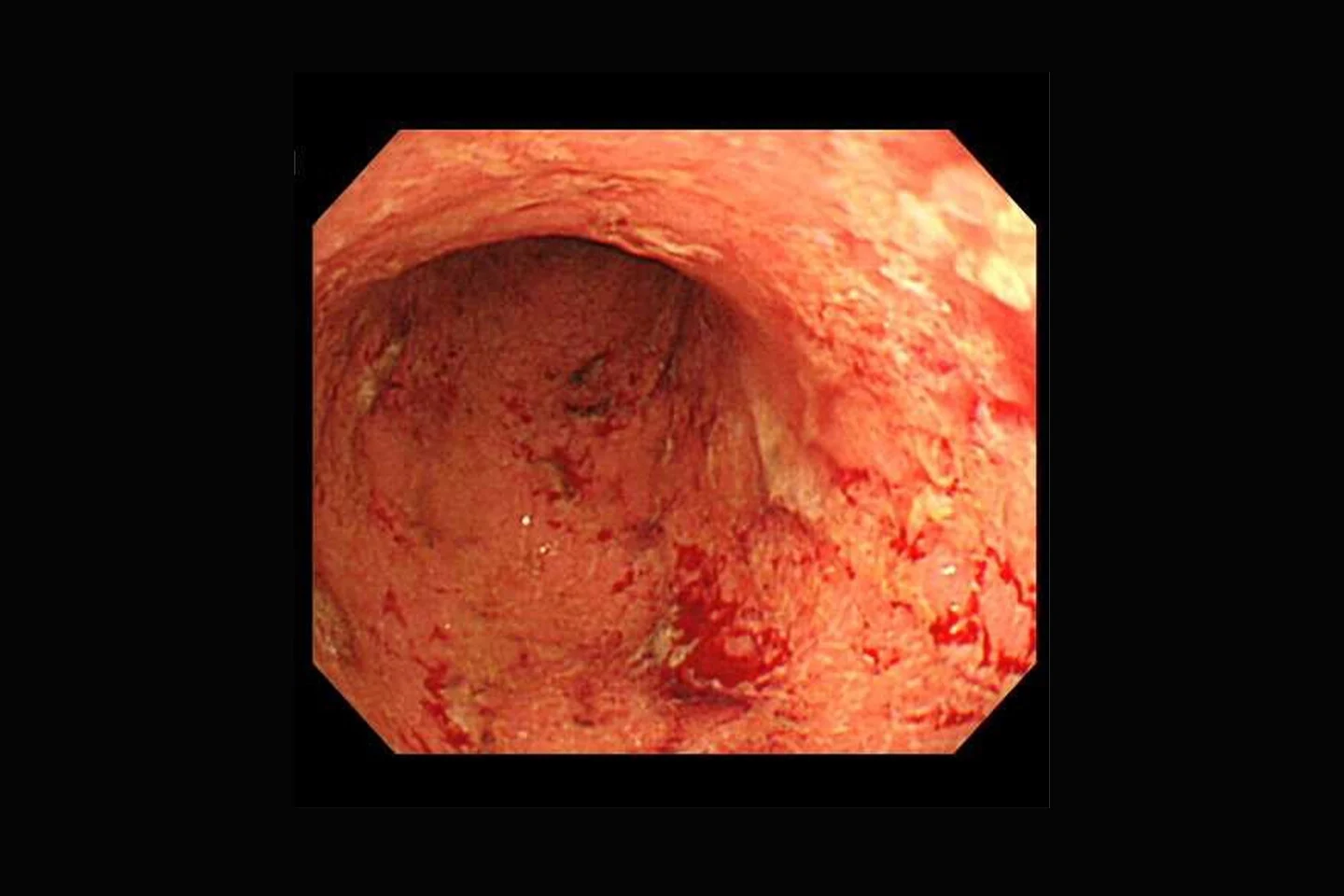潰瘍性大腸炎