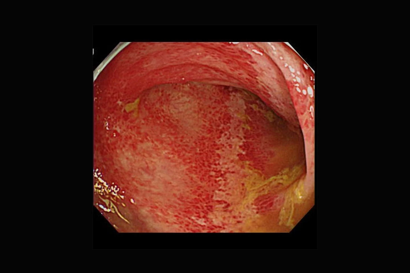 虚血性腸炎