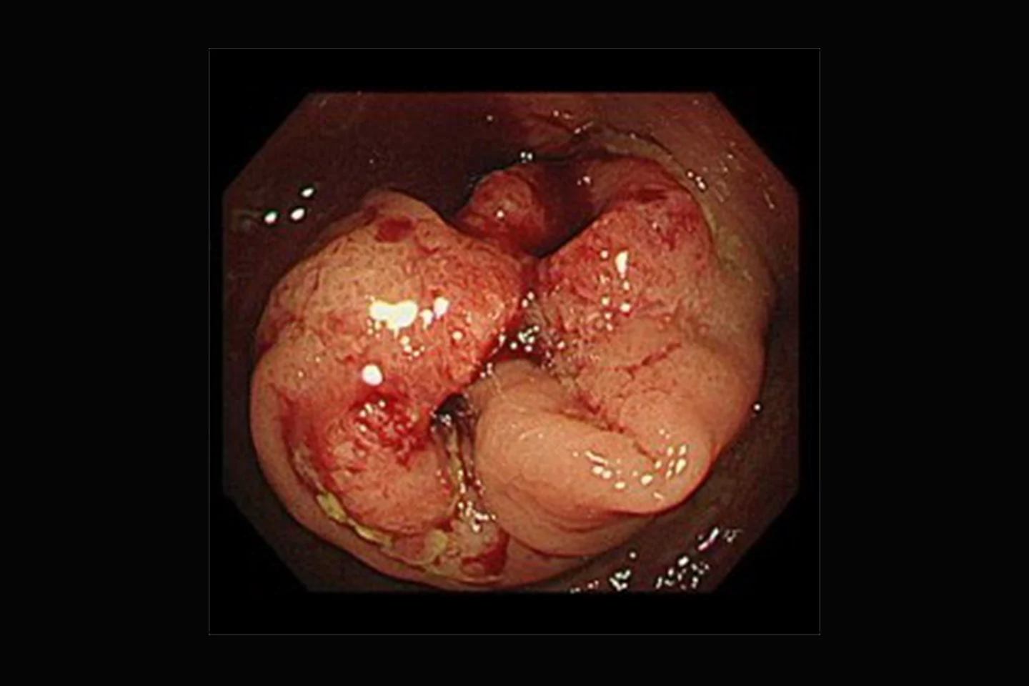 進行性大腸がん